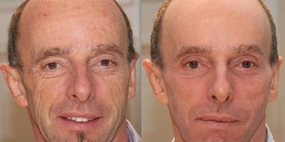 Combinatie behandeling fractionele laser en IPL-OPL