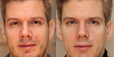 Litteken na een ongeval