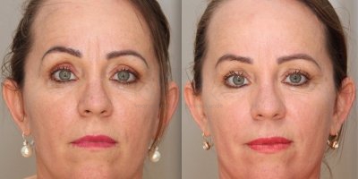 Rimpel vermindering met botox