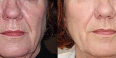 Diffuse roodheid en gebroken vaatjes