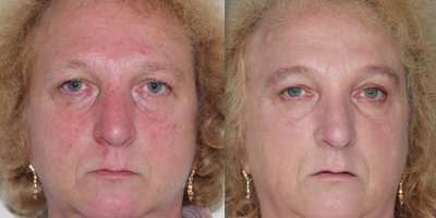 Diffuse roodheid, gebroken vaatjes en ontstekingen