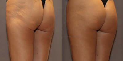 Combinatie behandeling truSculpt Flex en VelaShape III