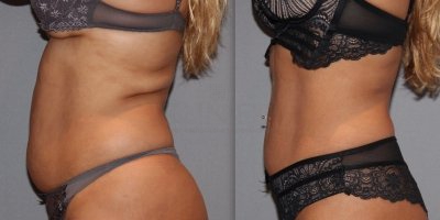 Vetreductie na UltraShape Power en dieet