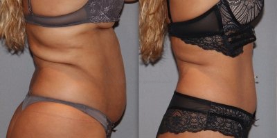 Vetreductie na UltraShape Power en dieet