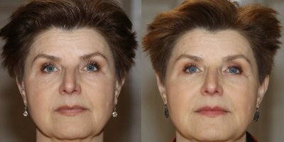 Volume verlies rond de mond