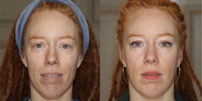 Volume verlies traangoten