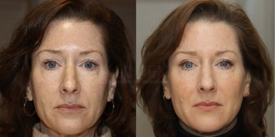 Volume verlies rond de mond