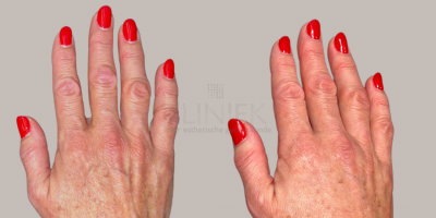 Volume verlies handen