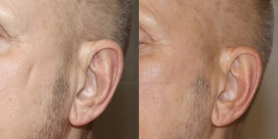 Opvullen van een "valley scar"