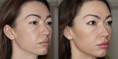 Correctie lippen, jukbeenderen en kaaklijn