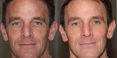 Pigmentvlekken gelaat door zon