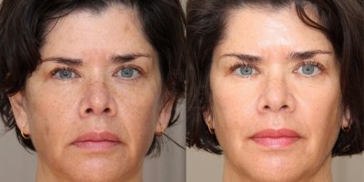 Pigmentvlekken en fijne lijntjes door zon