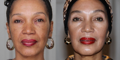 Grove pori&euml;n, zonbeschadiging en fijne lijntjes